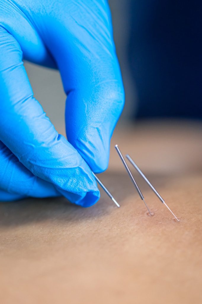 Acupuntura no outono: fortalecimento da imunidade e prevenção de doenças respiratórias