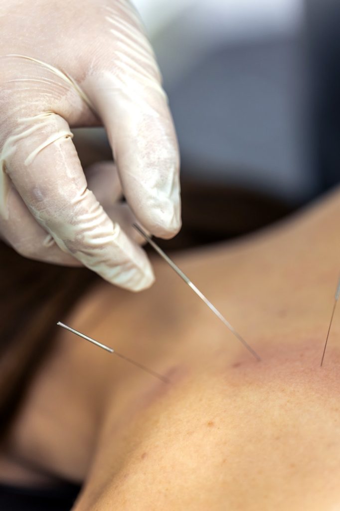 Acupuntura e TDAH e ansiedade: quando a técnica chinesa pode ser uma opção complementar?